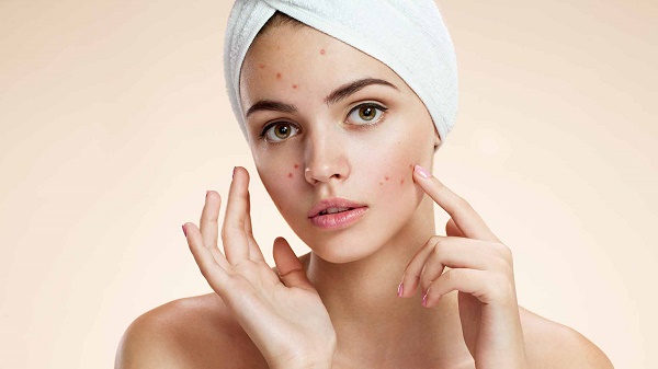 face acne removal cream hindi