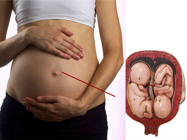 जुड़वा बच्चा पेट में होने से महिला को कैसा लगता है