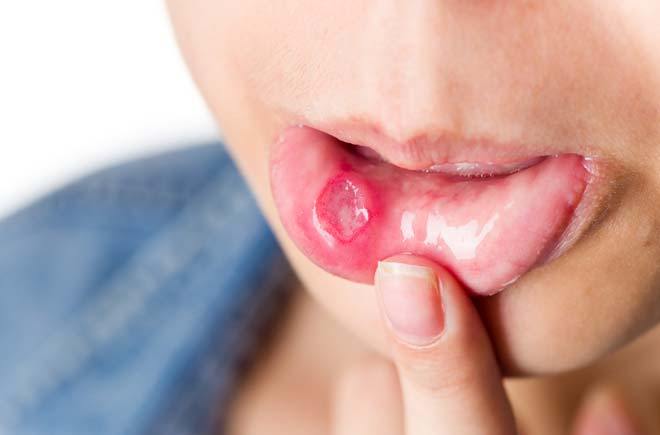 मुंह में छाले आने के लक्षण क्या है